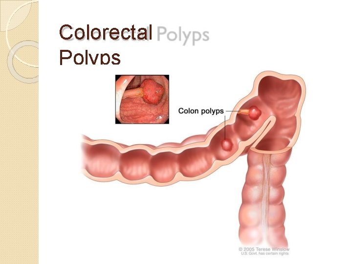 Colorectal Polyps 
