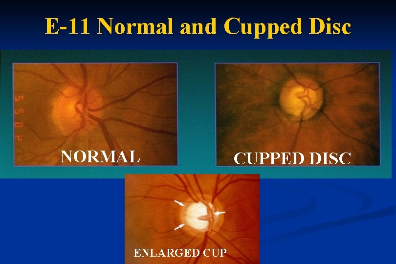 E-11 Normal and Cupped Disc NORMAL ENLARGED CUPPED DISC 