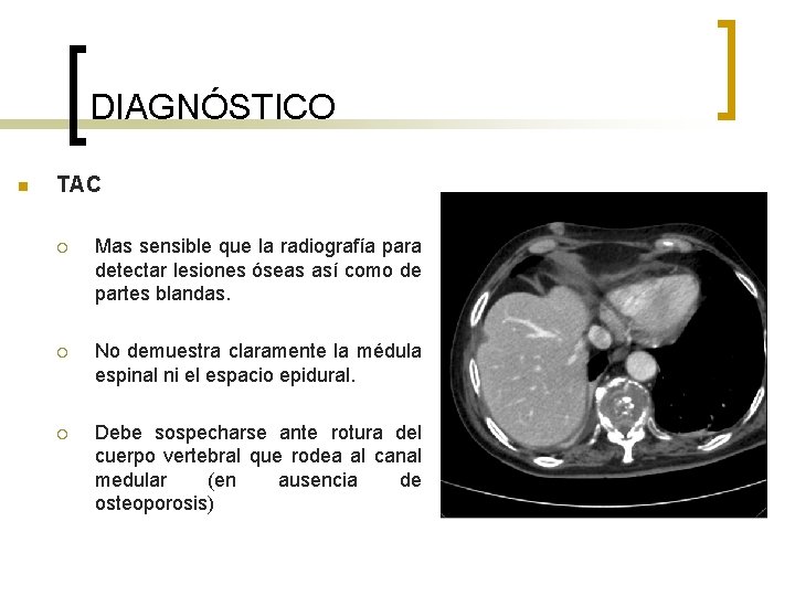 DIAGNÓSTICO n TAC ¡ Mas sensible que la radiografía para detectar lesiones óseas así