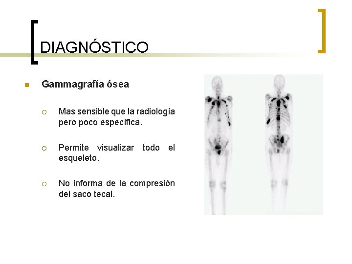 DIAGNÓSTICO n Gammagrafía ósea ¡ Mas sensible que la radiología pero poco específica. ¡