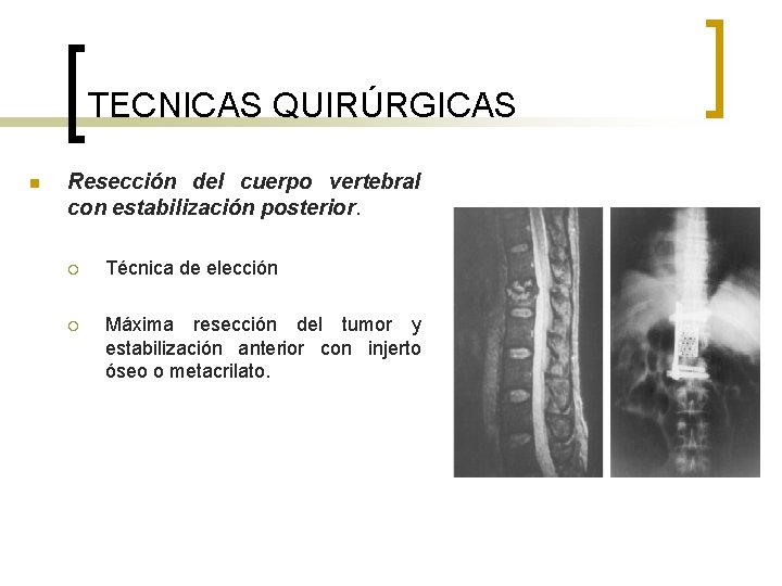 TECNICAS QUIRÚRGICAS n Resección del cuerpo vertebral con estabilización posterior. ¡ Técnica de elección