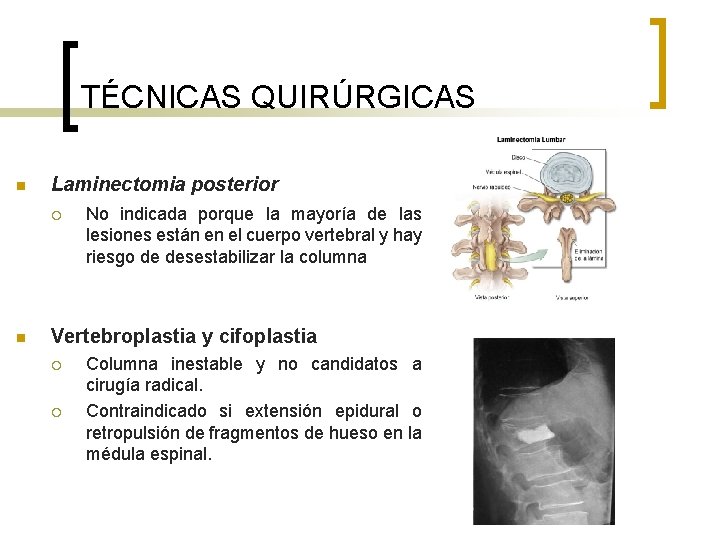 TÉCNICAS QUIRÚRGICAS n Laminectomia posterior ¡ n No indicada porque la mayoría de las