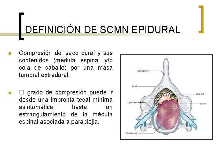 DEFINICIÓN DE SCMN EPIDURAL n Compresión del saco dural y sus contenidos (médula espinal