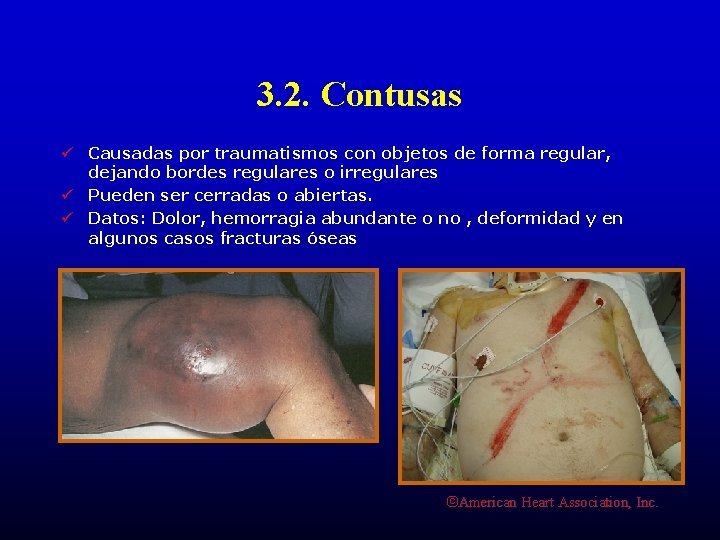 3. 2. Contusas ü Causadas por traumatismos con objetos de forma regular, dejando bordes