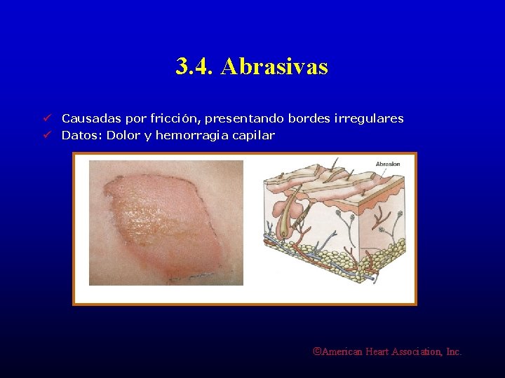 3. 4. Abrasivas ü Causadas por fricción, presentando bordes irregulares ü Datos: Dolor y
