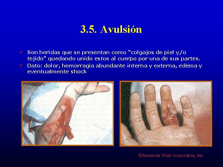 3. 5. Avulsión ü Son heridas que se presentan como “colgajos de piel y/o