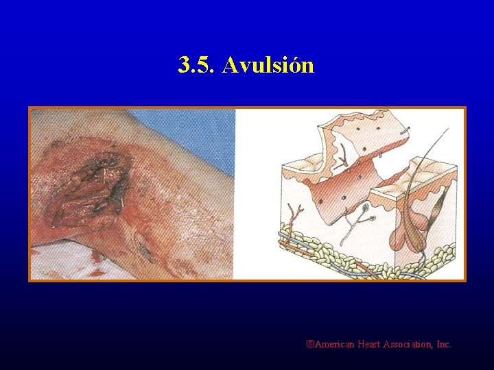 3. 5. Avulsión ©American Heart Association, Inc. 