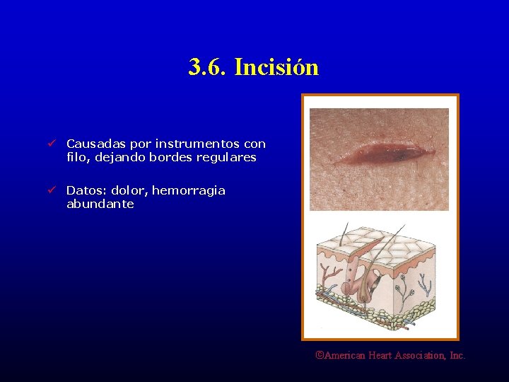 3. 6. Incisión ü Causadas por instrumentos con filo, dejando bordes regulares ü Datos:
