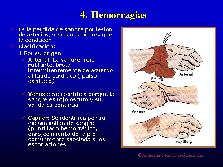 4. Hemorragias ü Es la pérdida de sangre por lesión de arterias, venas o