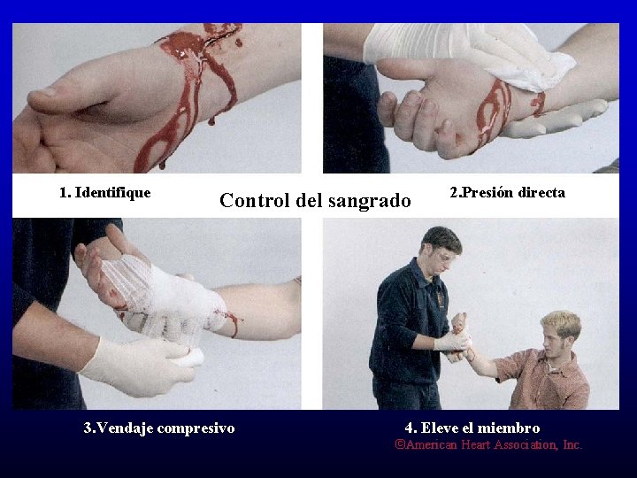 ü Aplique en forma sostenida una compresa estéril. De no contar con una presione