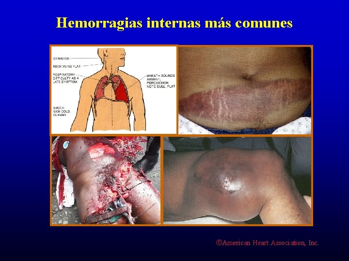 Hemorragias internas más comunes ©American Heart Association, Inc. 