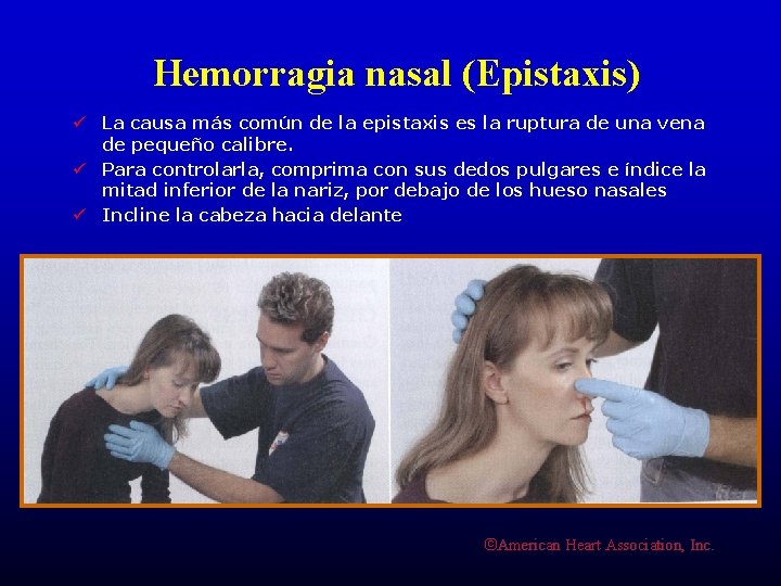 Hemorragia nasal (Epistaxis) ü La causa más común de la epistaxis es la ruptura