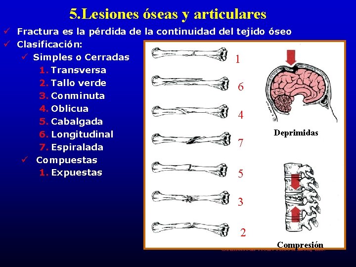 5. Lesiones óseas y articulares ü Fractura es la pérdida de la continuidad del