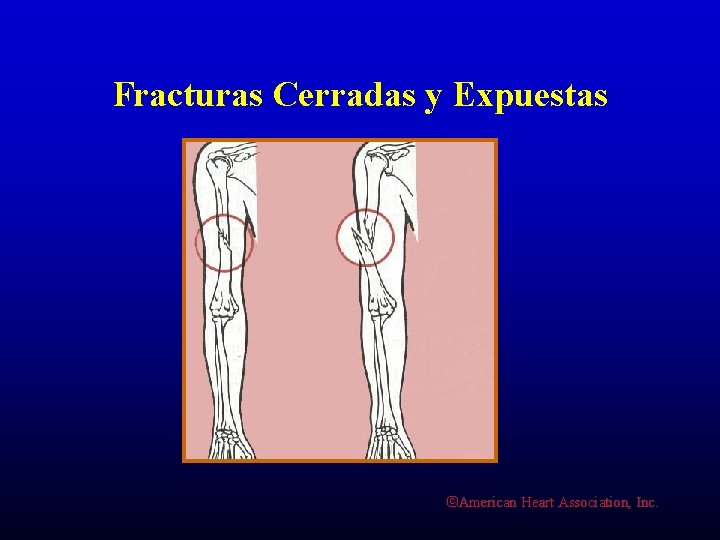 Fracturas Cerradas y Expuestas ©American Heart Association, Inc. 