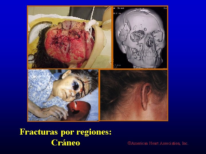 Fracturas por regiones: Cráneo ©American Heart Association, Inc. 