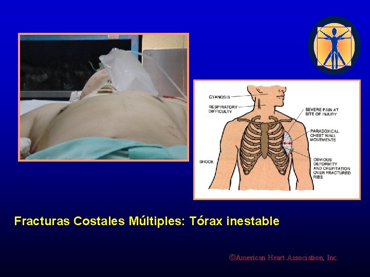 Fracturas Costales Múltiples: Tórax inestable ©American Heart Association, Inc. 