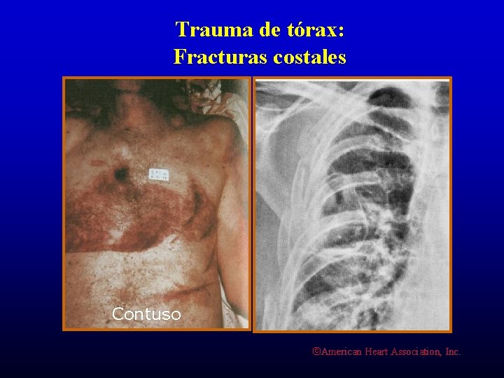 Trauma de tórax: Fracturas costales Contuso ©American Heart Association, Inc. 