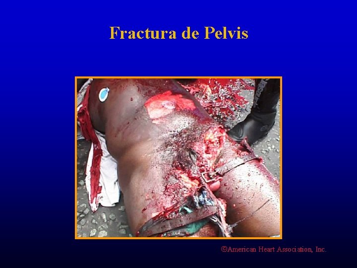 Fractura de Pelvis ©American Heart Association, Inc. 