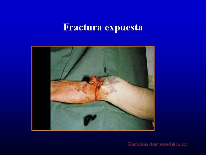 Fractura expuesta ©American Heart Association, Inc. 