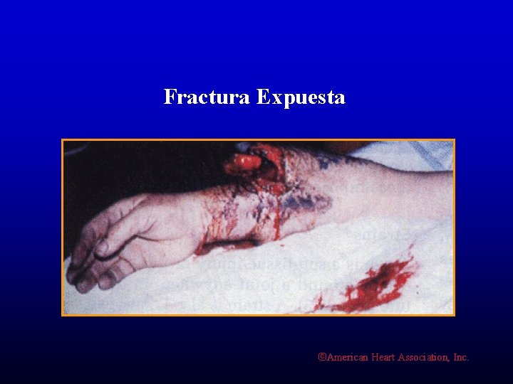 Fractura Expuesta ©American Heart Association, Inc. 