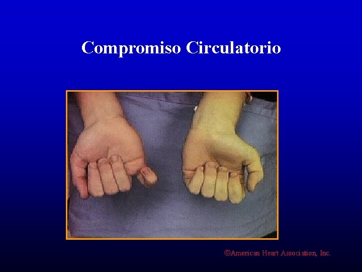 Compromiso Circulatorio ©American Heart Association, Inc. 