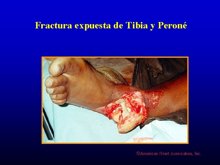 Fractura expuesta de Tibia y Peroné ©American Heart Association, Inc. 