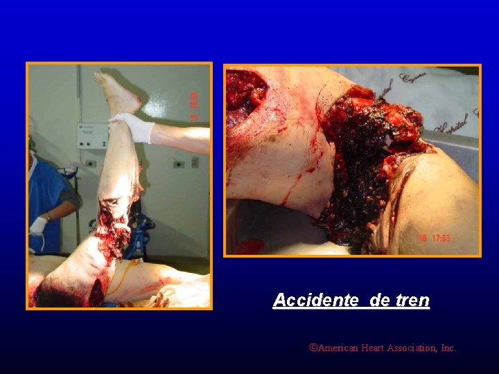 Accidente de tren ©American Heart Association, Inc. 