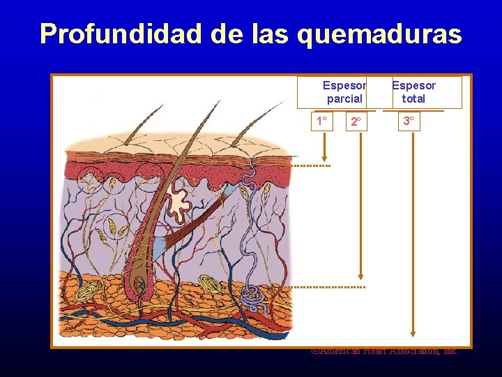 Profundidad de las quemaduras Espesor parcial 1° 2° Espesor total 3° ©American Heart Association,