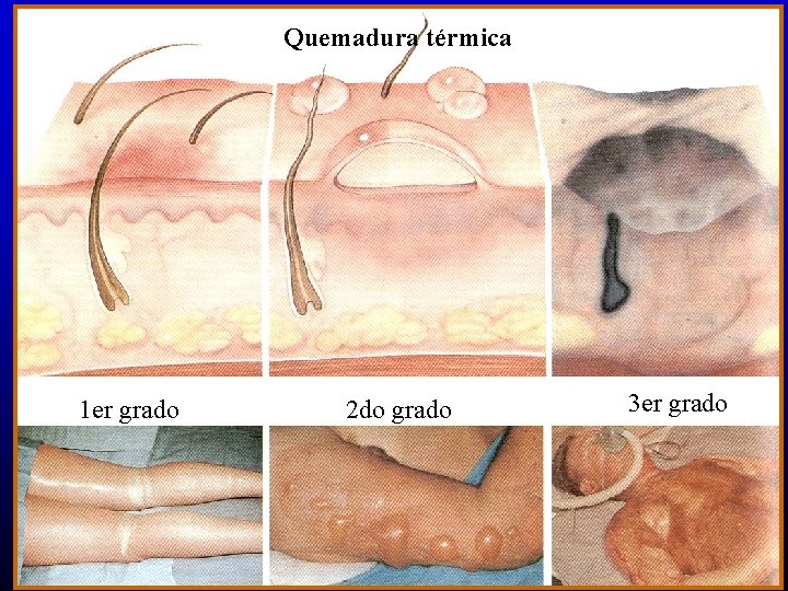 Quemadura térmica 1 er grado 2 do grado 3 er grado ©American Heart Association,