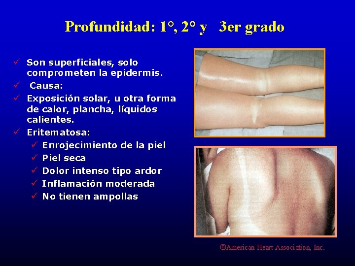 Profundidad: 1°, 2° y 3 er grado ü Son superficiales, solo comprometen la epidermis.