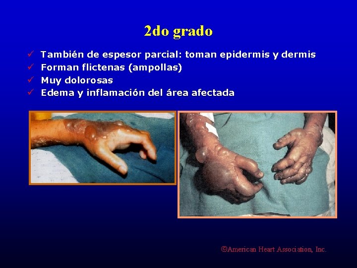 2 do grado ü ü También de espesor parcial: toman epidermis y dermis Forman