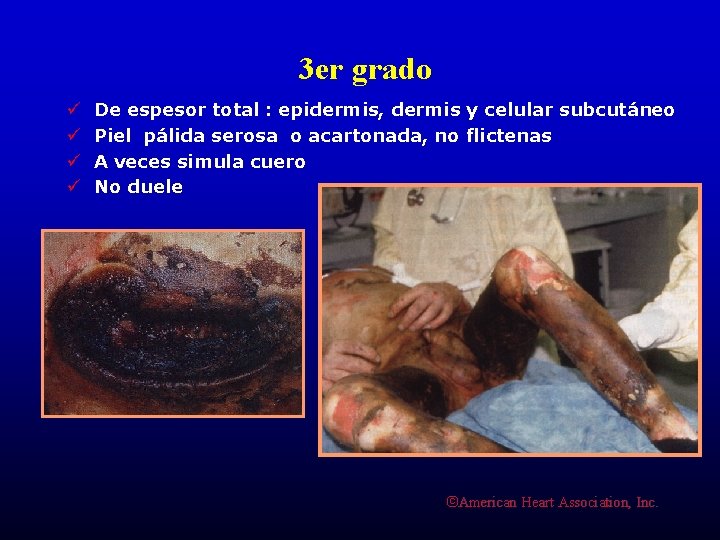 3 er grado ü ü De espesor total : epidermis, dermis y celular subcutáneo