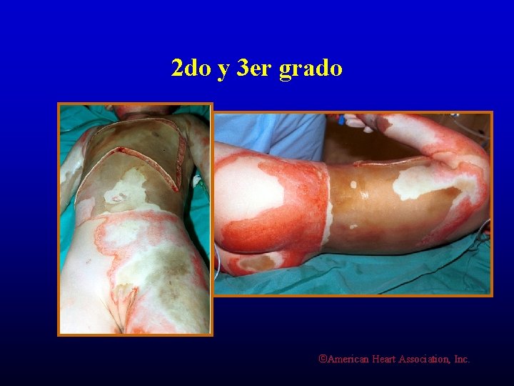 2 do y 3 er grado ©American Heart Association, Inc. 