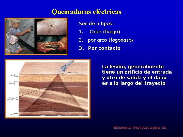 Quemaduras eléctricas Son de 3 tipos: 1. Calor (fuego) 2. por arco (fogonazo) 3.