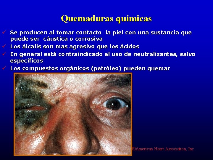 Quemaduras químicas ü Se producen al tomar contacto la piel con una sustancia que