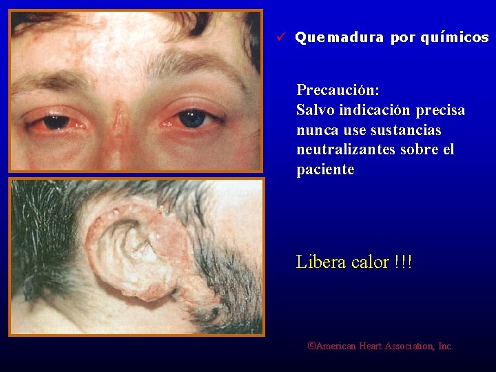ü Quemadura por químicos Precaución: Salvo indicación precisa nunca use sustancias neutralizantes sobre el