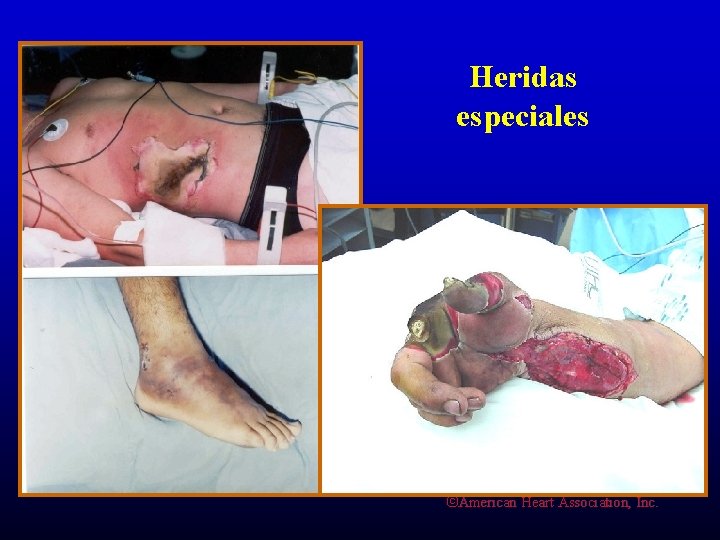 Heridas especiales ©American Heart Association, Inc. 