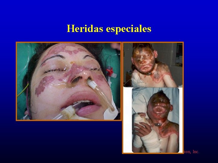 Heridas especiales ©American Heart Association, Inc. 
