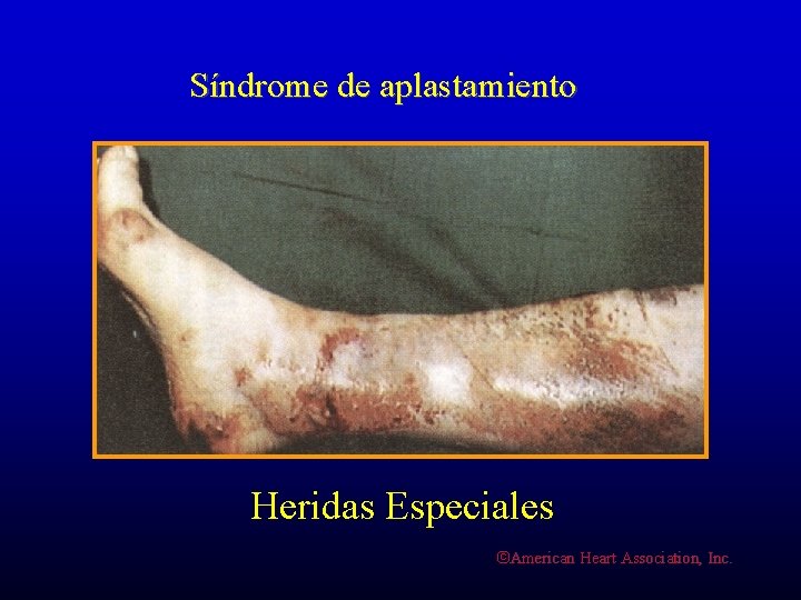 Síndrome de aplastamiento Heridas Especiales ©American Heart Association, Inc. 