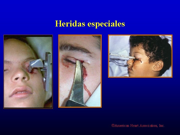 Heridas especiales ©American Heart Association, Inc. 