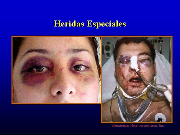 Heridas Especiales ©American Heart Association, Inc. 