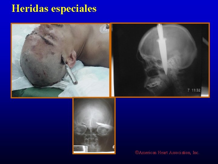 Heridas especiales ©American Heart Association, Inc. 