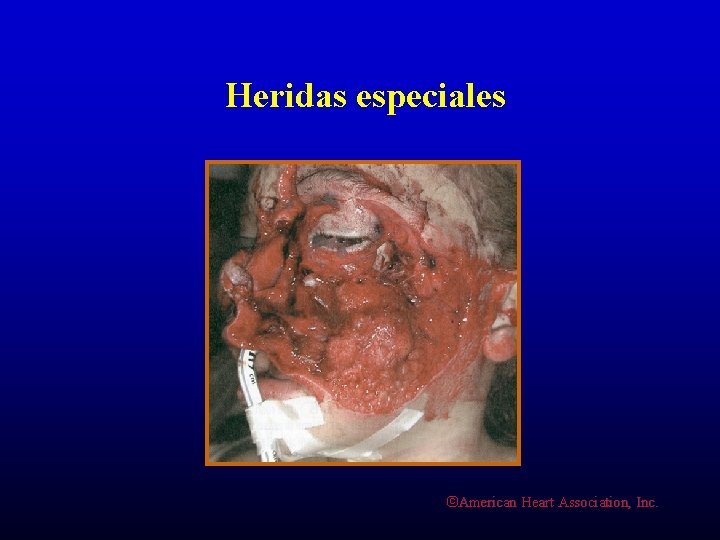 Heridas especiales ©American Heart Association, Inc. 