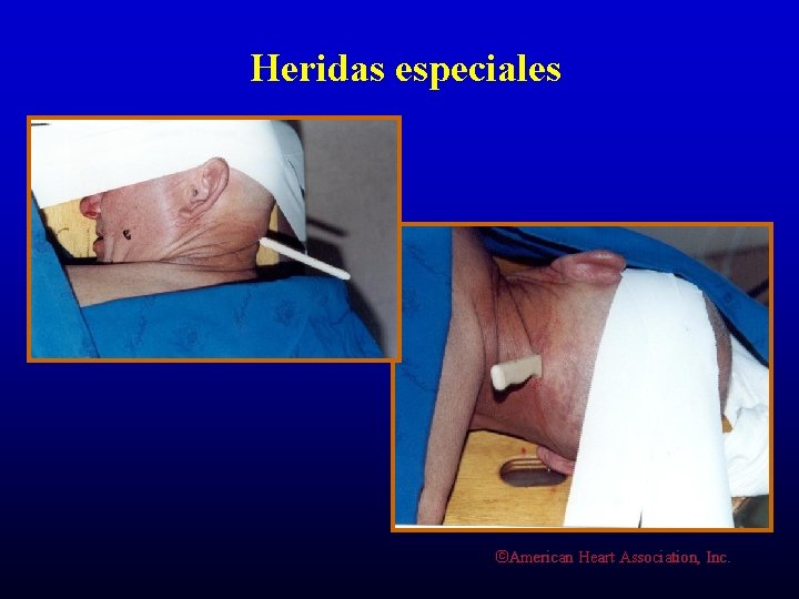 Heridas especiales ©American Heart Association, Inc. 