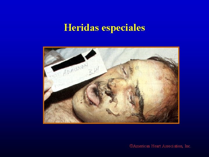 Heridas especiales ©American Heart Association, Inc. 