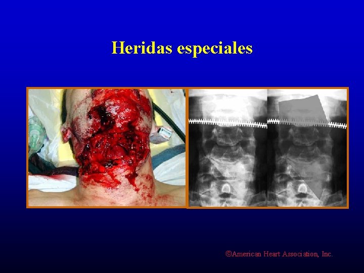 Heridas especiales ©American Heart Association, Inc. 