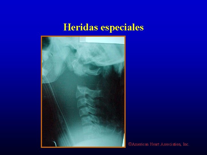Heridas especiales ©American Heart Association, Inc. 