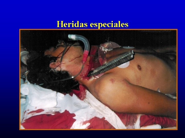 Heridas especiales ©American Heart Association, Inc. 