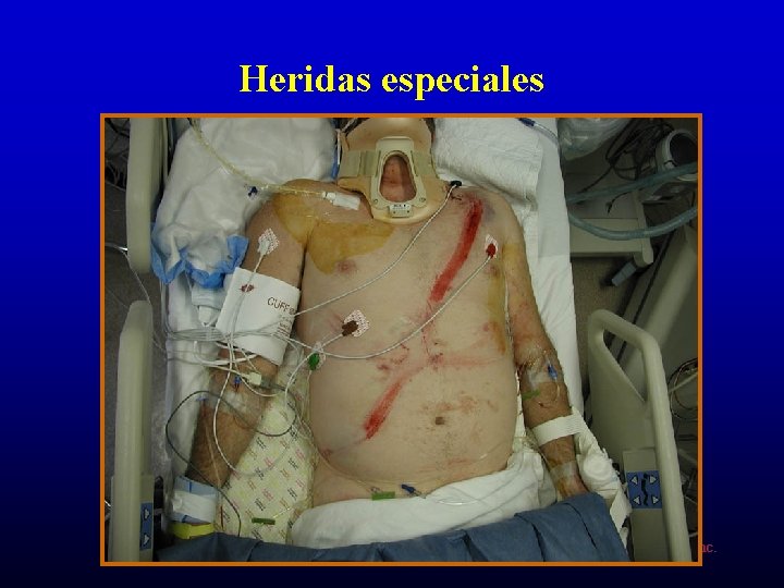 Heridas especiales ©American Heart Association, Inc. 