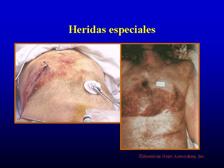 Heridas especiales ©American Heart Association, Inc. 